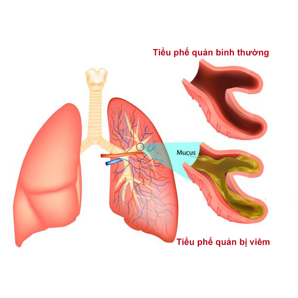 viêm tiểu phế quản