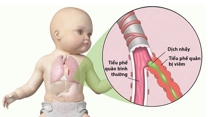 viêm tiểu phế quản